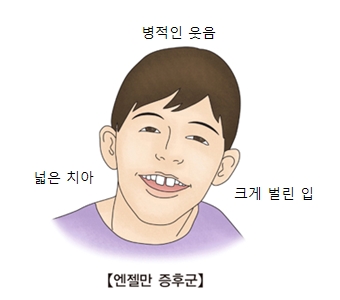 병적인 웃음 넓은치아 크게벌린입등 엔젤만 증후군의 대한 예시