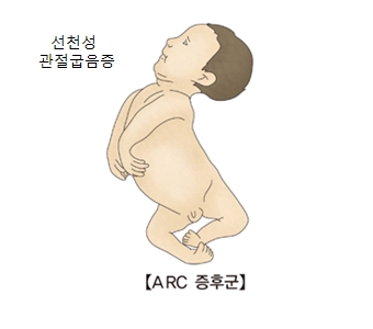 선천성 관절굽음증 ARC증후군의 예시