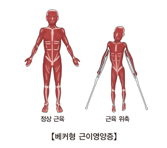 정상근육과및 근육위측등 베커형 근이영양증의 대한 예시 