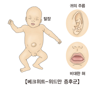 탈장 귀의주름 비대한 혀등 베크위트 위드만 증후군의 대한 예시