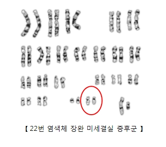 22번 염색체 장완 미세결실 증후군의 예시