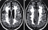 상염색체 우성 유전 질환인 CADASIL에 걸린 사람의 뇌 CT 사진