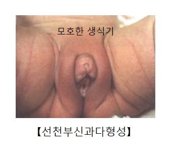 모호한 생식기등 선천부신과다형성의 예시