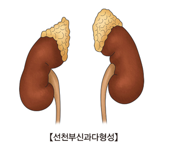 선천부신과다형성의 예시