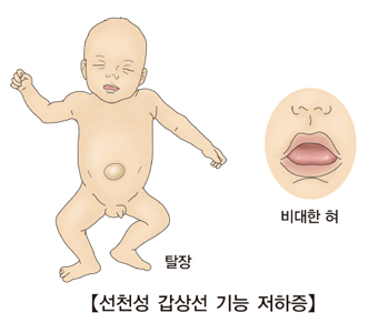 선천성 갑상선 기능저하증-탈장된 신생아와 비대한 혀 그림 예시