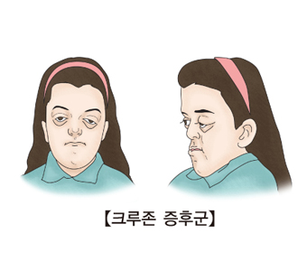 크루존 증후군 그림 예시