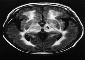 Haw River 증후군에 걸린 사람의 뇌 MRI 사진 예시