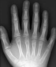 다지증에 걸린 사람의 손 X-ray 사진 예시