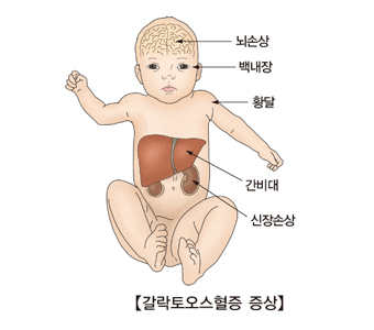 갈락토오스혈증 증상-뇌손상,백내장,황달,간비대,신장손상