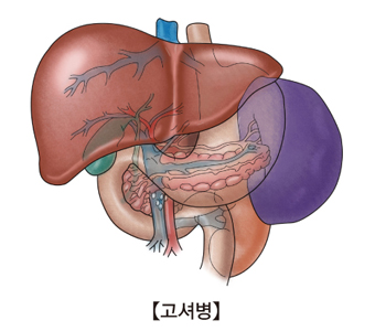 고셔병- 간,쓸개,췌장 그림 예시