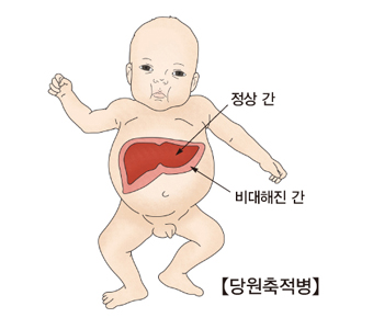 당원축적병-정상간과 비대해진 간 그림 예시