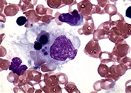 Hemophagocytic lymphohistiocytosis(FHL) 세포 사진 예시