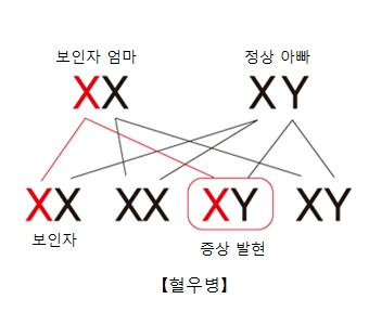 혈우병-보인자엄마와 정상아빠의 XY염색체로 증상발현이 된 그림 예시