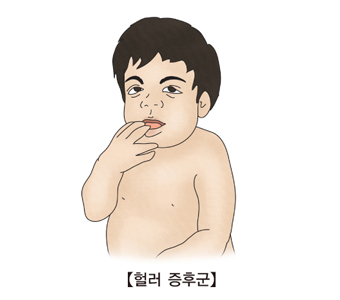 헐러 증후군 그림 예시