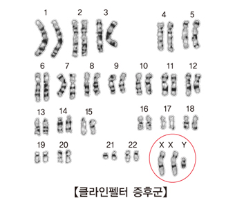 클라인펠터 증후군 염색체 그림 예시