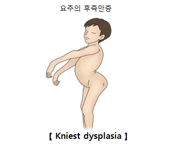 Kniest dysplasia-요추의 후측만증 그림 예시