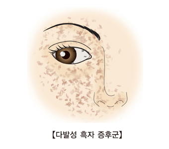 다발성 흑자 증후군 그림 예시