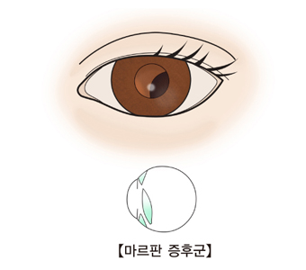 수정체가 이탈된 눈