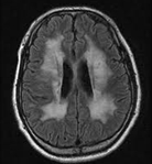 백질이영양증 발병된 사람의 뇌 MRI 사진 예시