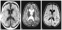 메틸말론산증이 발병된 사람의 MRI 사진