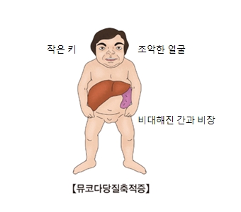 뮤코다당질축적증-작은키,조악한얼굴,비대해진 간과 비장