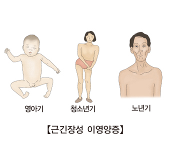 근긴장성 이영양증의 영아기,청소년기,노년기