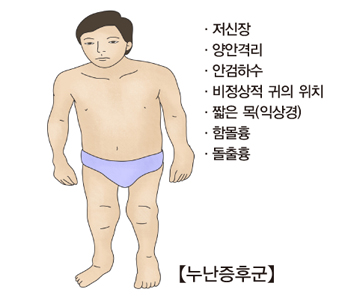 누난증후군-저신장,양안격리,안검하수,비정상적귀의위치,짧은목(익상경),함몰흉,돌출흉