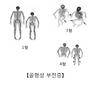 골형성 부전증-1형,3형,4형 그림 예시