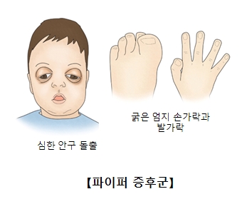 파이퍼증후군-심한안구돌출된아이,굵은엄지손가락과 발가락 그림 예시