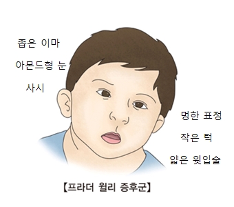 프라더 월리 증후군-좁은이마,아몬드형눈,사시,멍한표정,작은턱,얇은윗입술