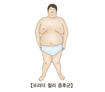 프라더 월리 증후군 그림 예시