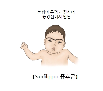 Sanfilippo증후군-눈썹이 두껍고 진하며 중앙선에서 만난 신생아의 그림 예시