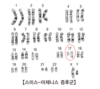 스미스-마제니스 증후군 그림 예시