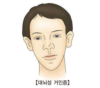 대뇌성 거인증-대뇌성거인증에걸린 남성