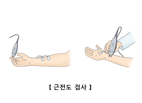 근전도검사-상완과 대퇴부의 근육에 작은 바늘을 놓고 검사기기를 연결하여 근육의 전자활동을 기록하게 되고 관찰하고있음