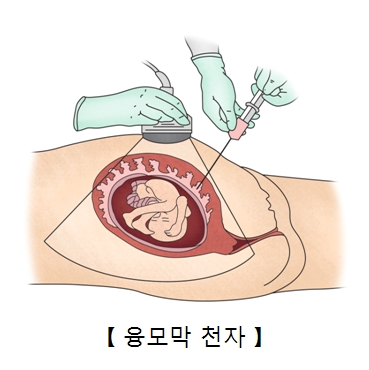 융모막 천자-융모막검사를 하고있음