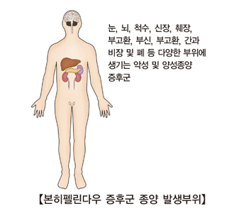 본히펠린다우 증후군 종양 발생부위-눈,뇌,척수,신장,췌장,부고환,부신,부고환,간과비장 및 폐등 다양한 부위에 생기는 악성 및 양성종양 증후군