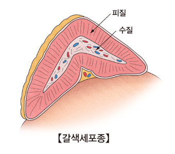 갈색세포증 그림예시및 피질,수질의 위치