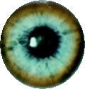 slit lamp 검사통해 본 각막-각막환증세