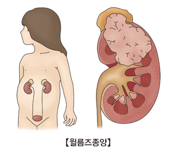 웰름즈종양 그림 예시