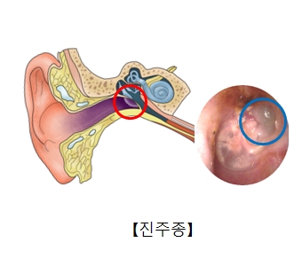 이경검사를 통해 본 진주종의 모습