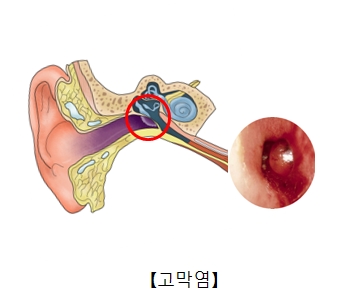 이경검사로본 고막염의 사진