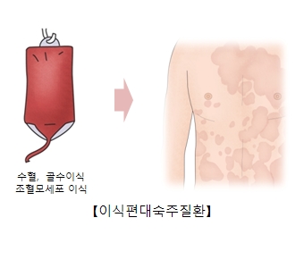 수혈 골수이식 조혈모세포이식 등으로인한 이식편대숙주질환 예시 