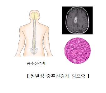 중추신경계 및 원발성 중추신경계 림프종의 예시