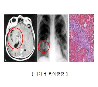 베게너육아종증에 감연된 신장의 X-ray 흉부X-ray 베게너육아종세포의모습