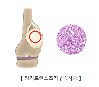 관절주변 링거르한스조직구증식증의 예시