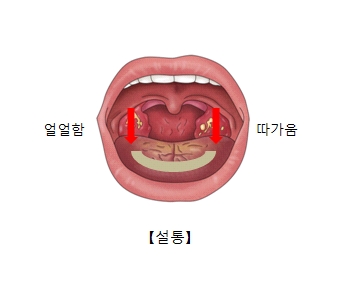 설통으로 느끼는 얼얼함 따가움이 발생되는 입안 위치의 예시