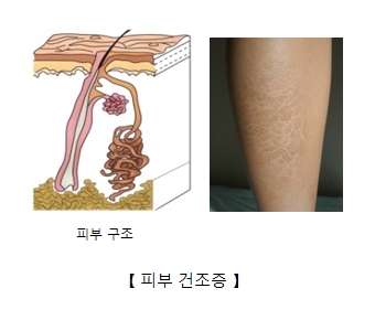 우리몸의 피부의 구조예시 및 실제 종아리 주변 피부건조증이 생긴 예시