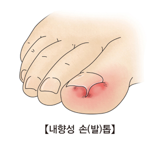 내형성 손발톱의 예시