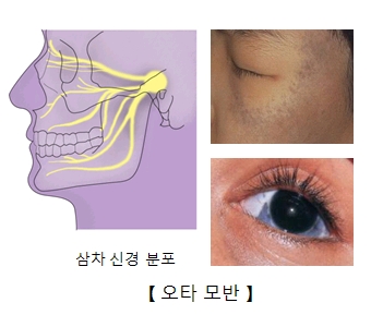 삼차 신경 분표의 예시및 눈 주변및 눈가의 오타모반 예시 